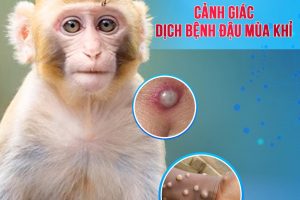 <b>Khác biệt giữa phát ban do COVID-19 và Đậu Mùa Khỉ</b>